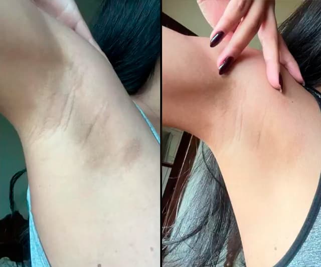 Antes e Depois Axilas